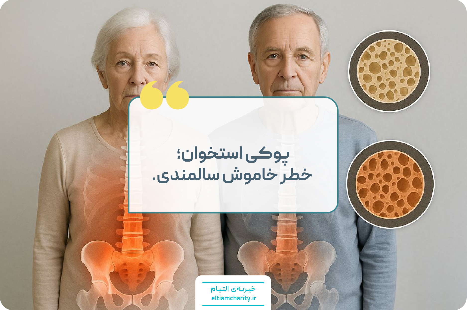 پوکی استخوان در سالمندان: پیشگیری و درمان